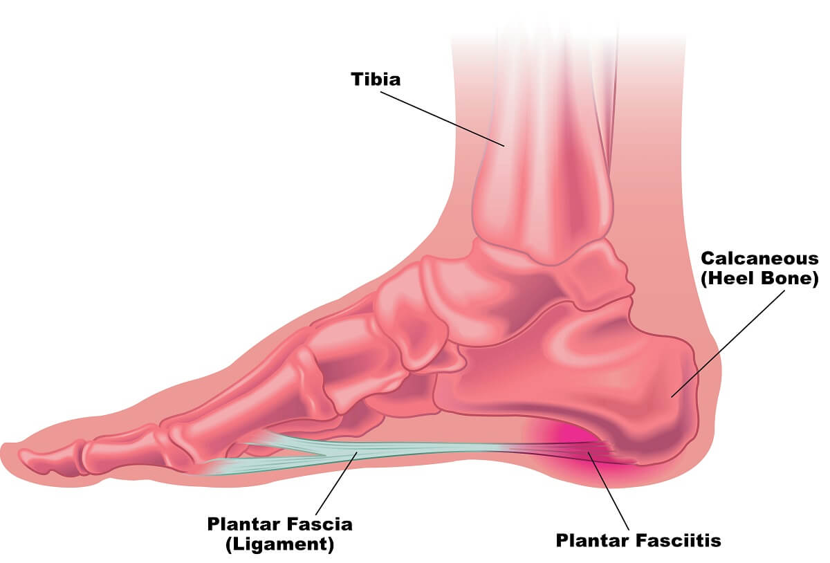 Plantar Fasciitis Diagram