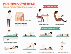 Piriformis Syndrome: A Pain in the Butt! - By Dr. Louise Bullard