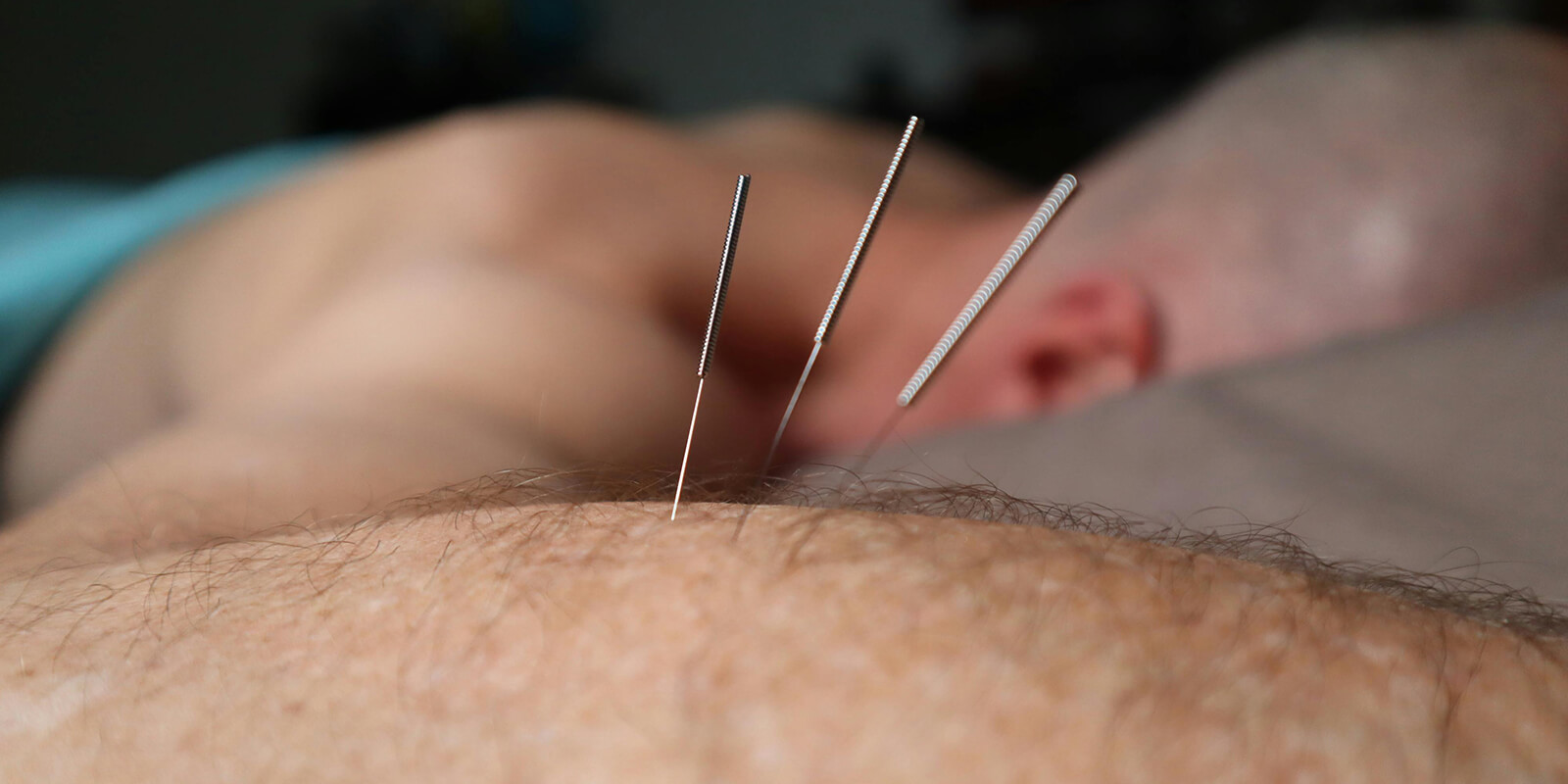 Dry Needling