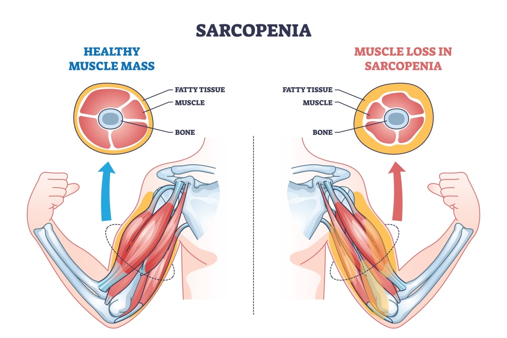 Sarcopenia