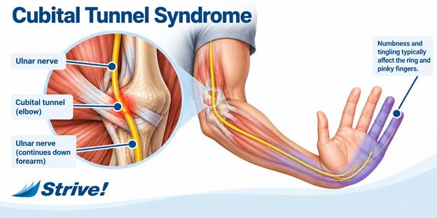 Cubital Tunnel Syndrome